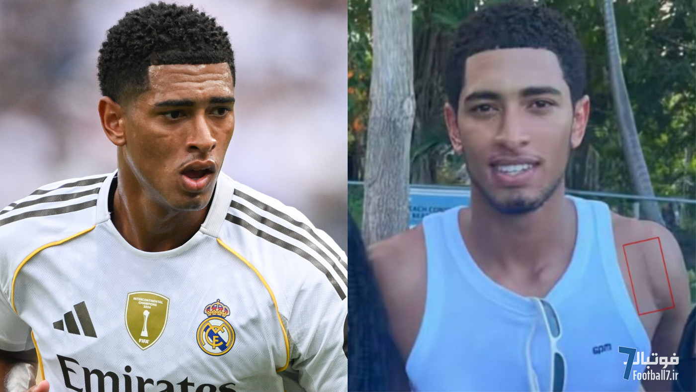 دوری احتمالی بلینگام از آغاز فصل 2025-2026؛ جای زخم جراحی ستاره رئال مادرید نمایان شد